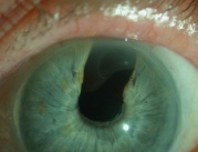 lien vers iridectomie sectorielle