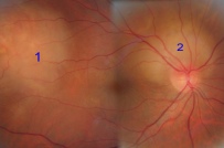 lien vers métastases oculaires