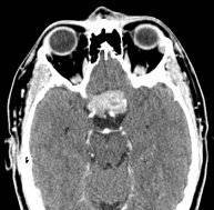lien vers neurinome du chiasma optique