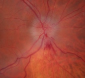 lien vers neuropathie optique ischémique antérieure aiguë