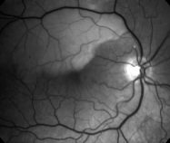 lien vers infarctus artèriolaire rétinien
