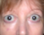 lien vers rétraction des paupières supérieures dues à une hyperthyroïdie