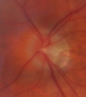 lien vers névrite optique covid