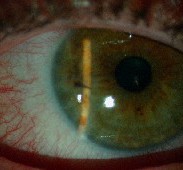 lien vers perforation oculaire