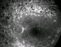 lien vers panphotocoagulation rétinienne au laser