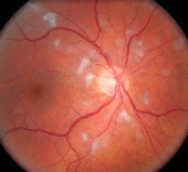 lien vers nodules dysoriques