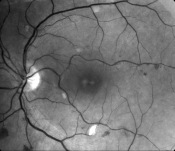 lien vers rétinopathie hypertensive