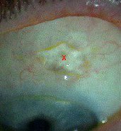 lien vers chirurgie fistulisante du glaucome chronique