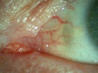 lien vers sonde lacrymale bi-canaliculo-nasale