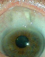lien vers chirurgie fistulisante du glaucome chronique